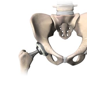 A diagram of a hip replacement