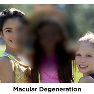 An example of macular degeneration