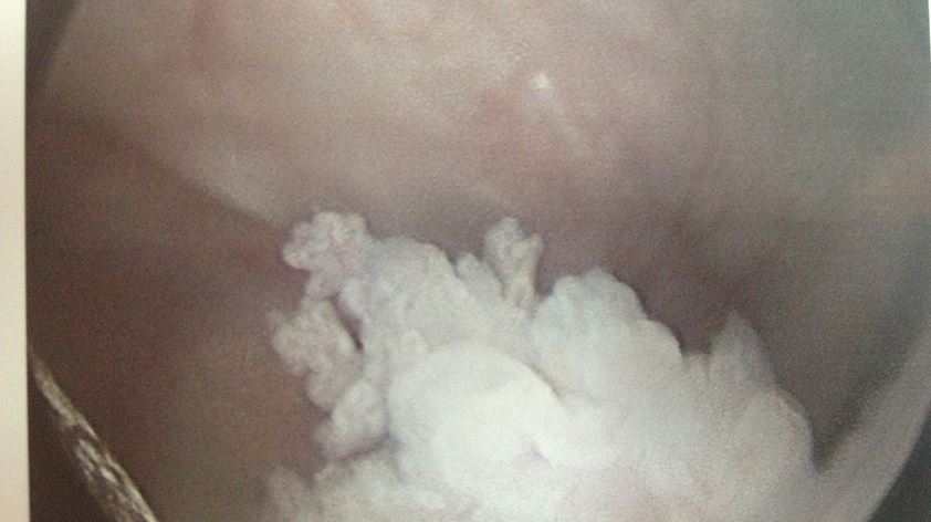 Fig 4: Bladder cancer at cystoscopy presenting with haematuria