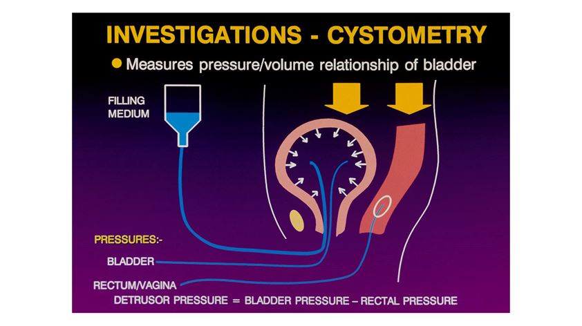   Fig 1:  How detrusor pressures are measured during Urodynamic studies