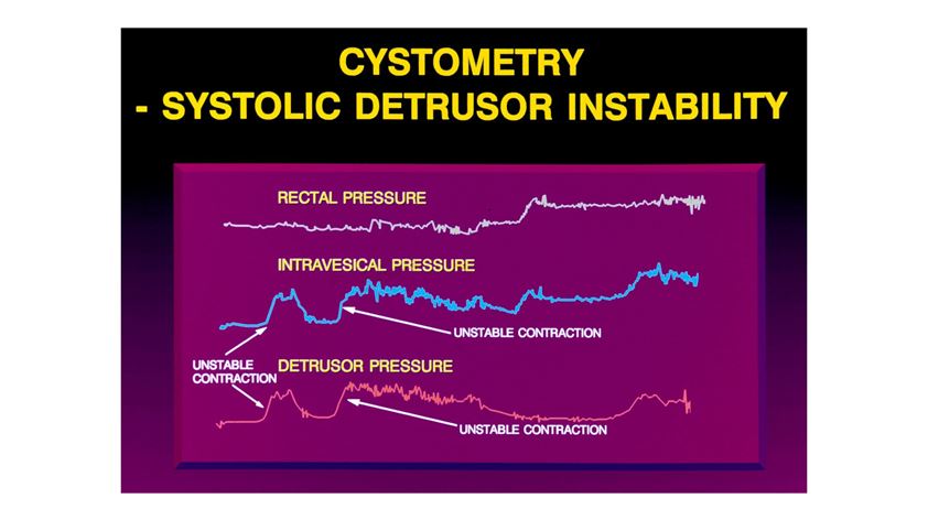 Fig 3: Urodynamic study showing detrusor overactivity