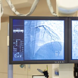 Cardiac Ablation
