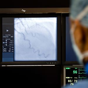 Coronary Angiogram