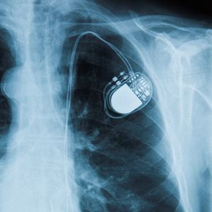 Pacemaker Placement