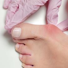 Bunion Surgery – Your Recovery