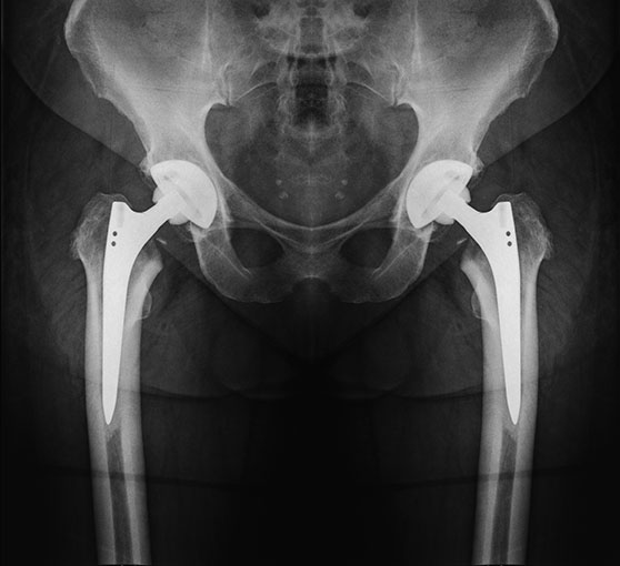 Bilateral Hip Replacement X-Ray