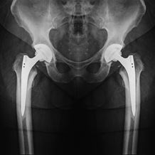 Bilateral Hip Replacement X-Ray