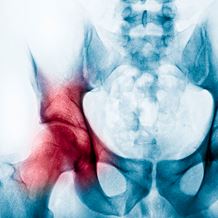 orthopaedics hip surgeries dysplasia xray pain