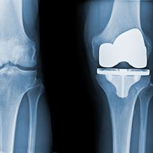 orthopaedics knee replacement total