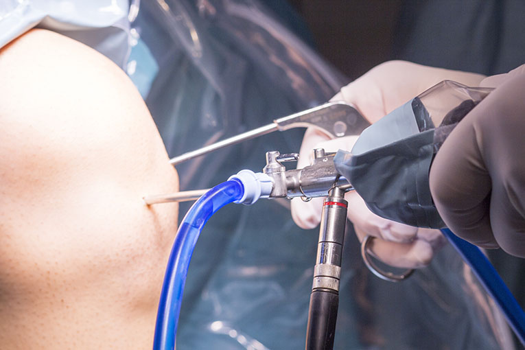 Knee Arthroscopy surgery operation