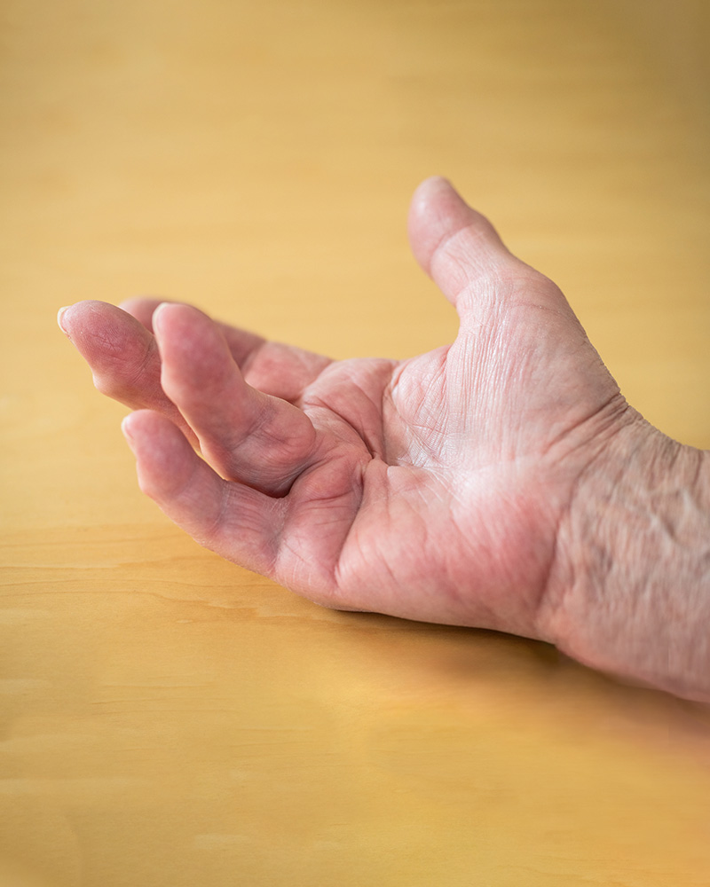 Dupuytren’s Contracture Surgery Your Recovery