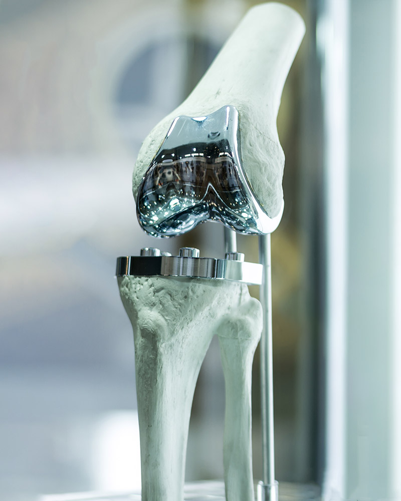 Knee Replacement Surgery in Melbourne I Orthopaedics I St Vincent’s