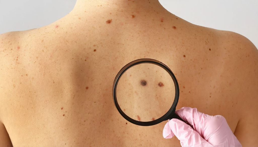 Skin Cancer Action Week