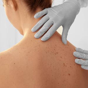 A doctor checks for skin cancer